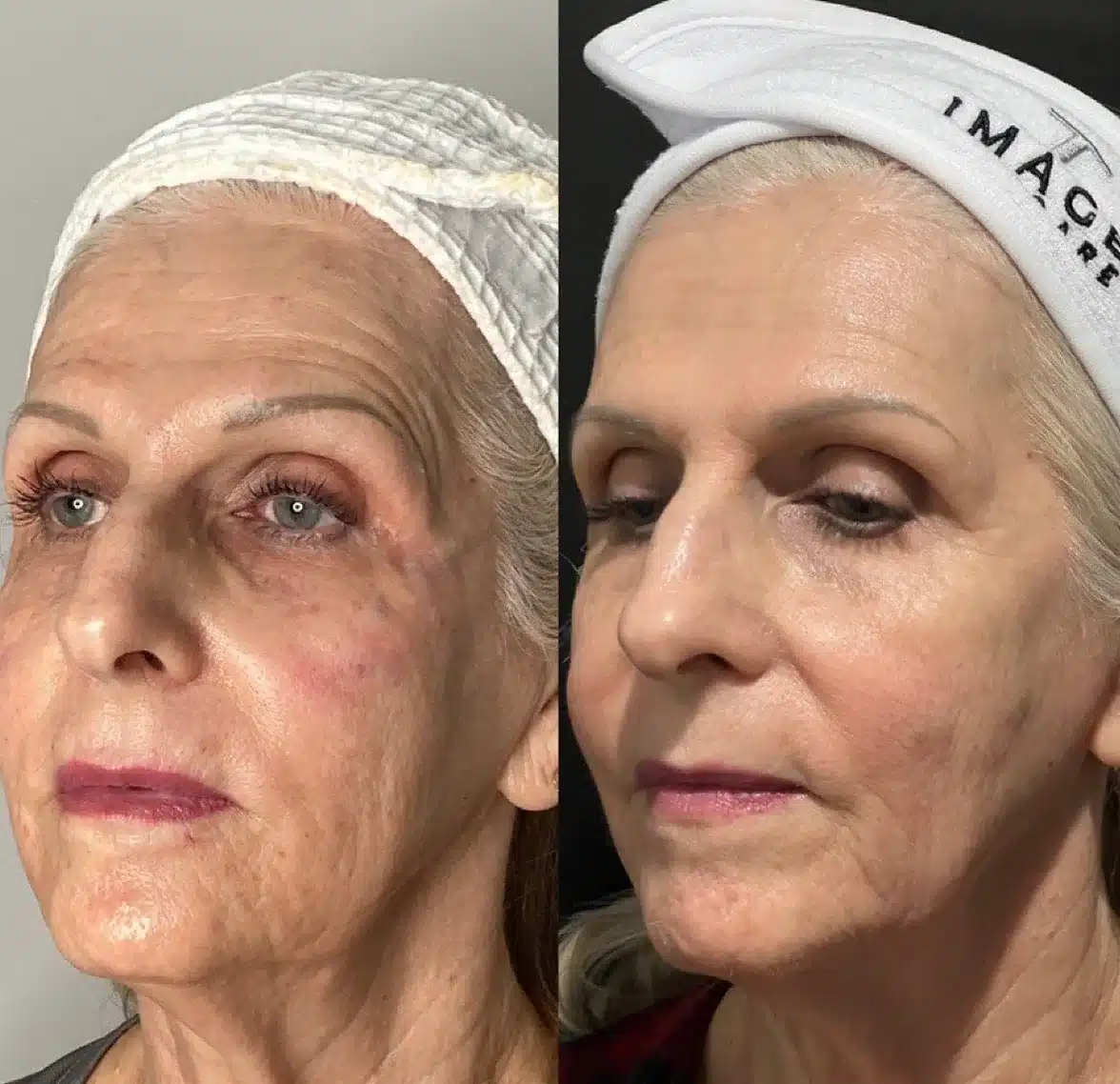 Before and After Image: Aesthetics - left-front-oblique