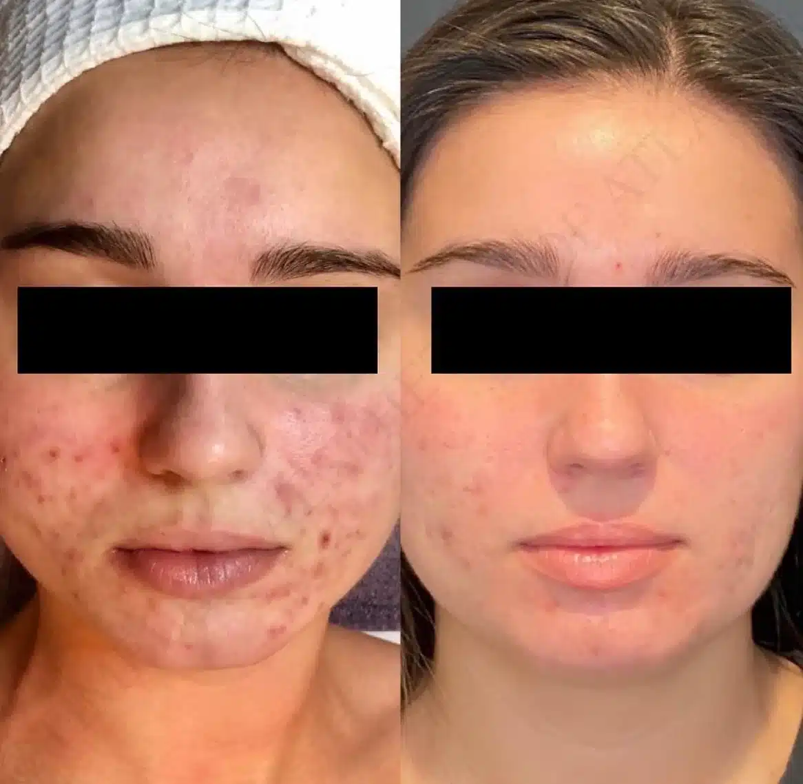 Before and After Image: Aesthetics - front