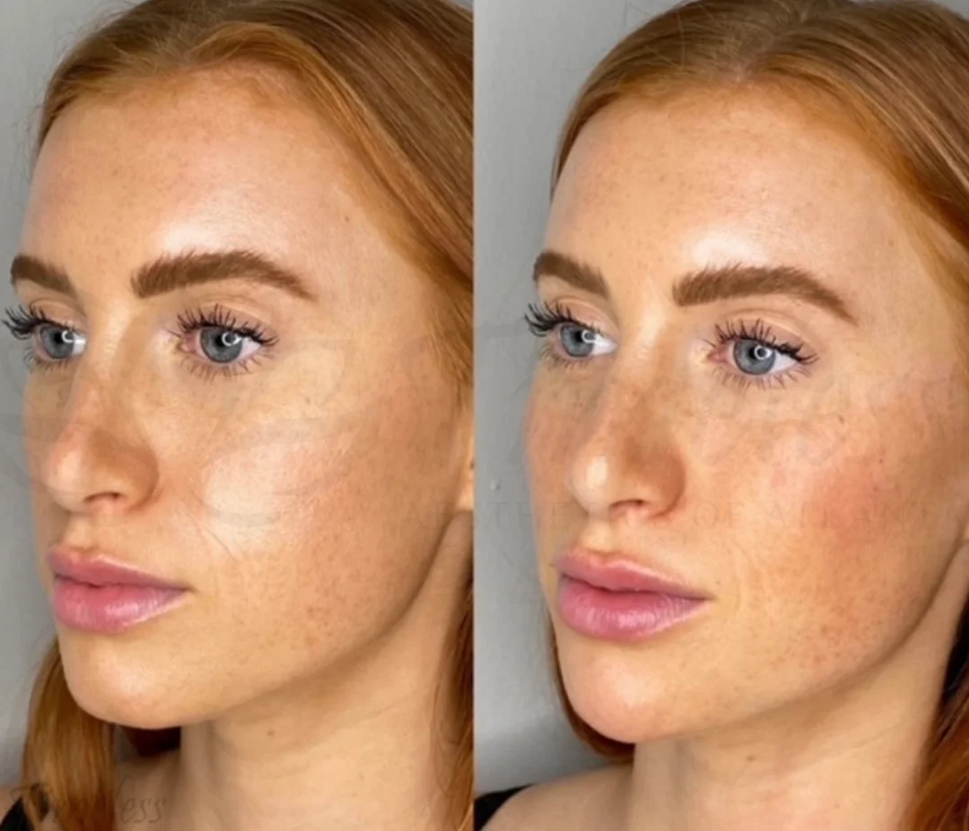 Before and After Image: Injectables - left-front-oblique