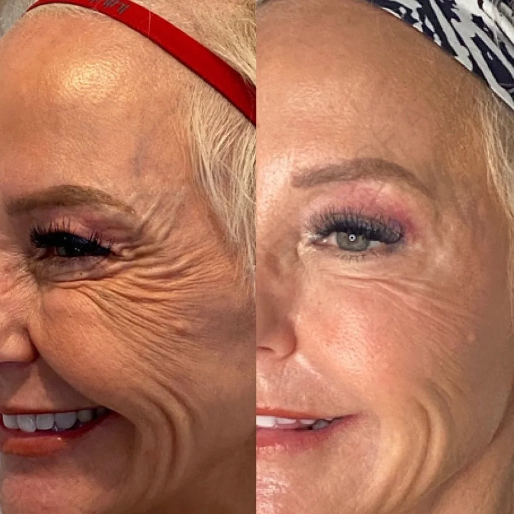 Before and After Image: Injectables - left-front-oblique