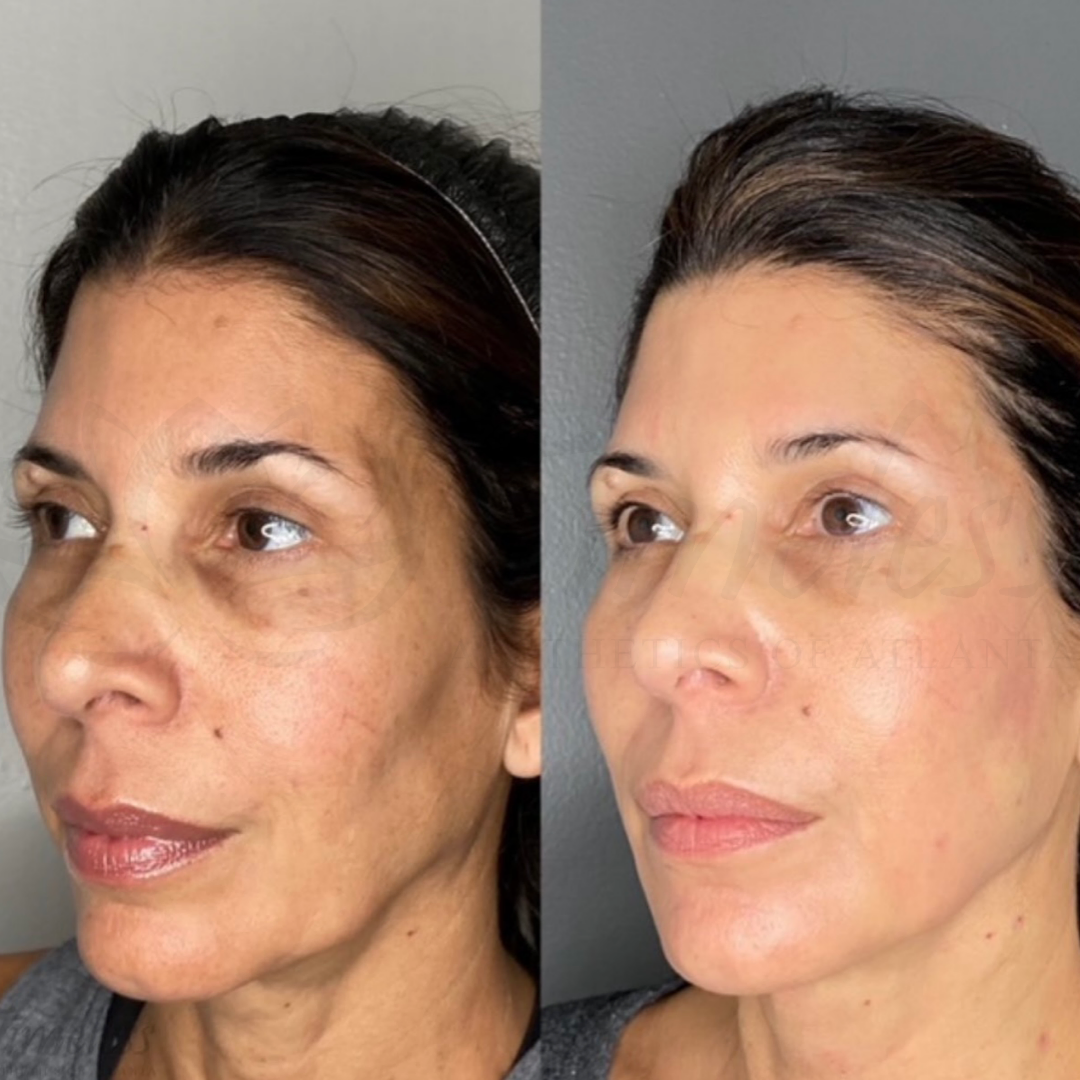 Before and After Image: Injectables - left-front-oblique