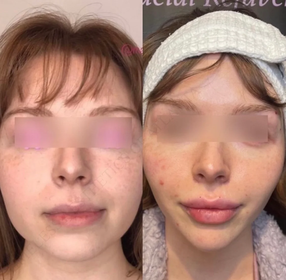 Before and After Image: Injectables - front