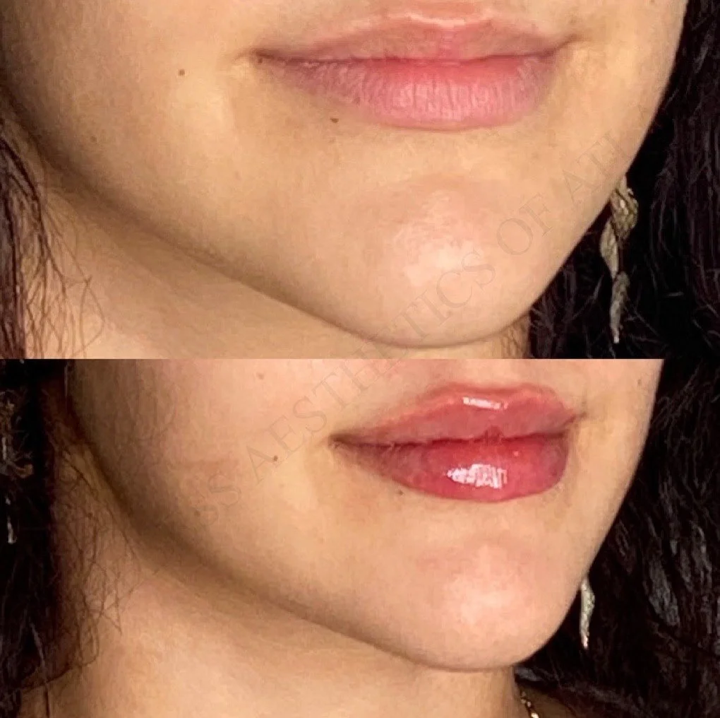 Before and After Image: Injectables - right-front-oblique