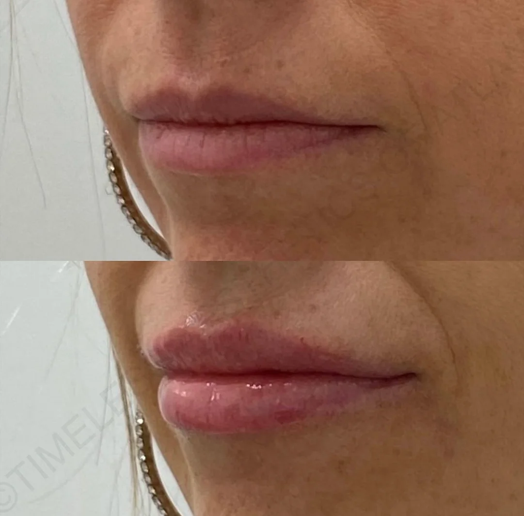 Before and After Image: Injectables - left-front-oblique