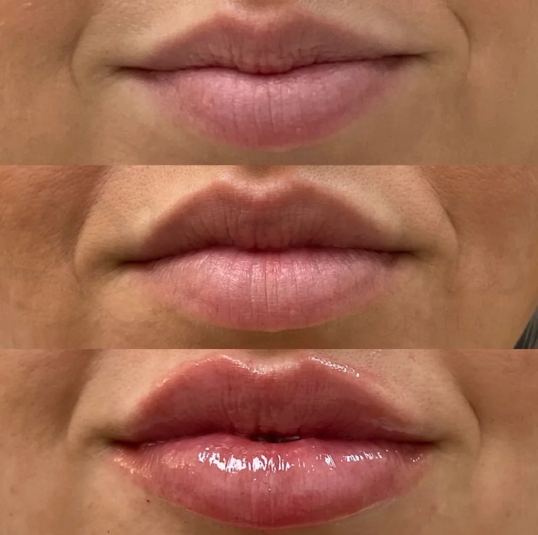 Before and After Image: Injectables - front