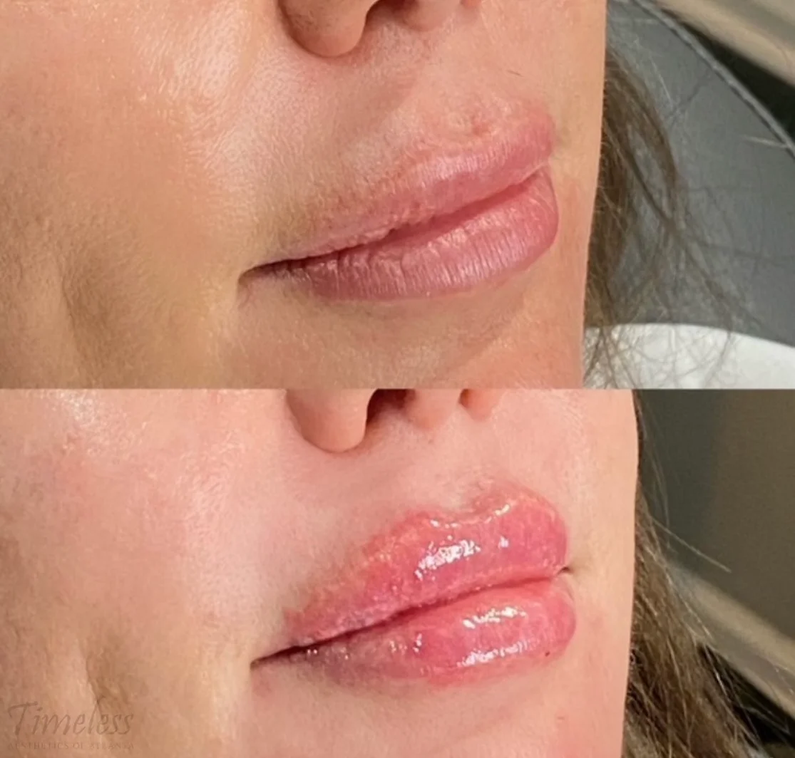 Before and After Image: Injectables - right-front-oblique