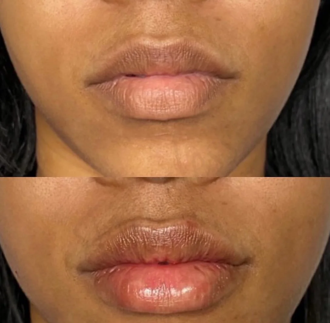 Before and After Image: Injectables - front